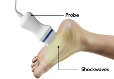 Shock Wave Therapy (SWT)