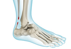 Achilles Tendinitis and Rupture