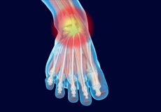 Chronic Lateral Ankle Instability