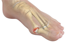 Hallux Rigidus (Stiff Big Toe)