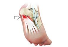 Posterior Heel Pain