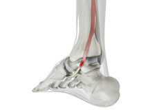 Posterior Tibial Dysfunction (Acquired Flatfoot)