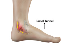 Tarsal Tunnel Syndrome